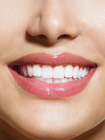 veneers